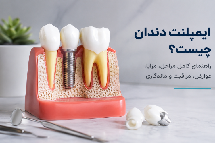 ایمپلنت دندان چیست؟ راهنمای کامل مراحل، مزایا، عوارض، مراقبت و ماندگاری